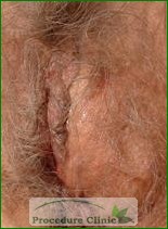 bartholin cyst